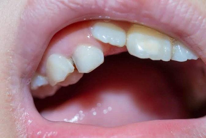 Why Are My Child's Permanent Teeth Coming In Crooked? | Articles | Revive Dental | Gan Jing World - Technology for Humanity | Video & Movie Streaming