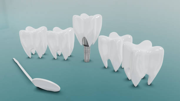 Can a Dental Implant Be Replaced If It Fails? – Telegraph