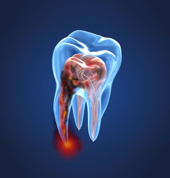 Why Does a Tooth Sometimes Hurt After Root Canal Treatment? – Telegraph