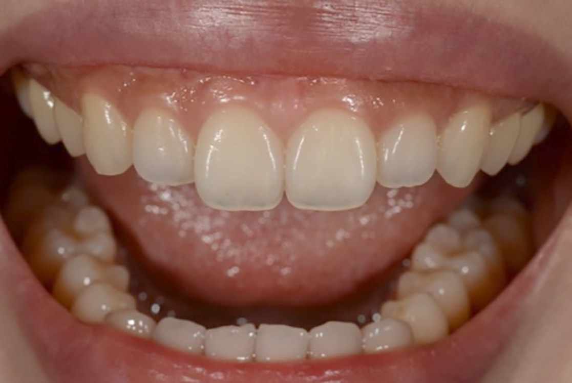 Small Dental Changes That Can Prevent Bigger Problems Later