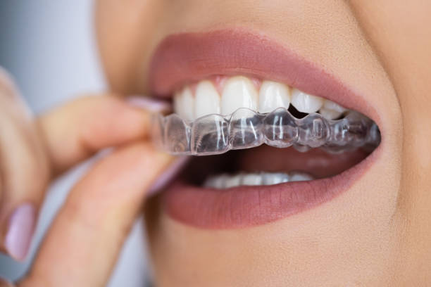 Why Can Teeth Shift Even After Years of Having a Straight Smile? – Telegraph